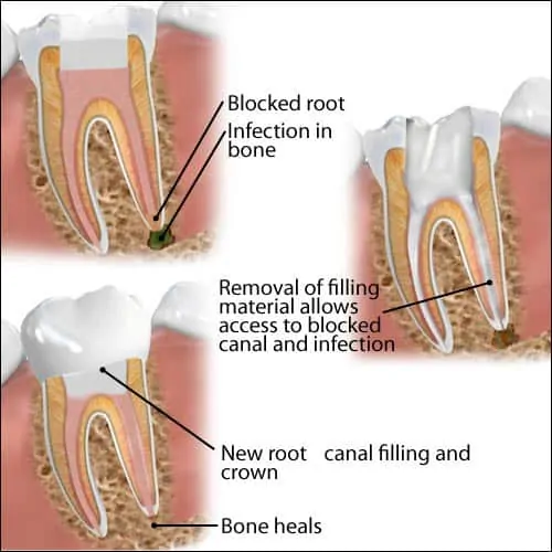 Root Canal Retreatment Photo