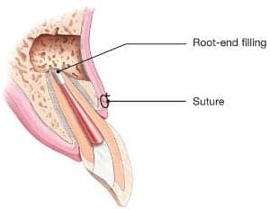 Second Root Canal Surgery Photo