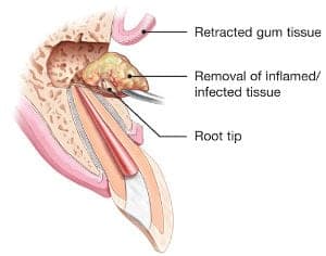 Root Canal Surgery Photo