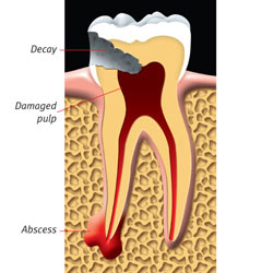 Infected Tooth Photo