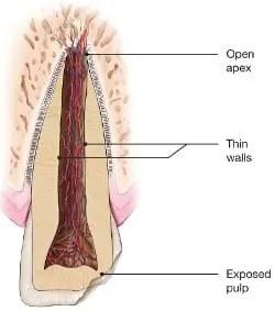 Apexification Photo