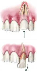 Traumatic Dental Injury Photo